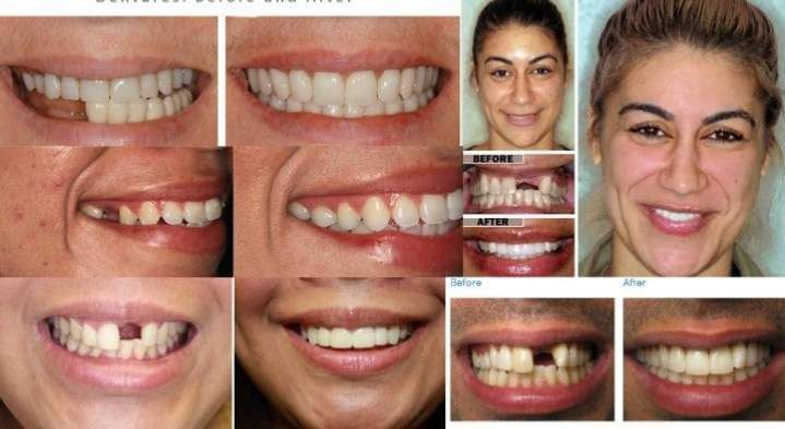 We can help replace your missing teeth