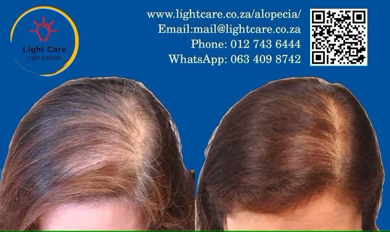 Alopecia - Hair Loss