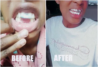 Perfect smile Cut-Able teeth veneers, suitable for top or bottom Cut &amp; Use