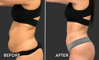 R70 000.00 Hiemt EMSCULPT -used Good condition