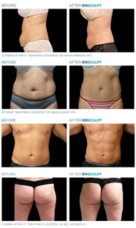 R70 000.00 Hiemt EMSCULPT -used Good condition