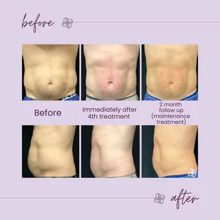 R70 000.00 Hiemt EMSCULPT -used Good condition