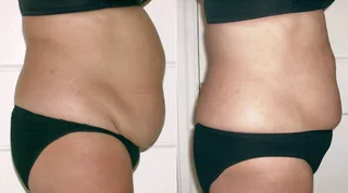 R70 000.00 Hiemt EMSCULPT -used Good condition