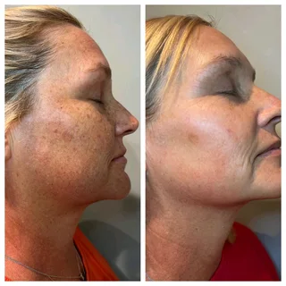 R59 000.00 Elight IPL plus RF Hair removal plus 8 in 1 Skin machine-used