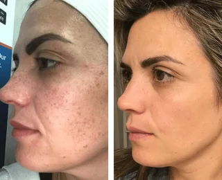 R59 000.00 Elight IPL plus RF Hair removal plus 8 in 1 Skin machine-used