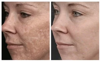 R59 000.00 Elight IPL plus RF Hair removal plus 8 in 1 Skin machine-used