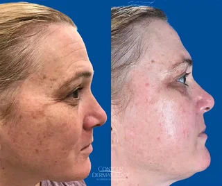 R59 000.00 Elight IPL plus RF Hair removal plus 8 in 1 Skin machine-used